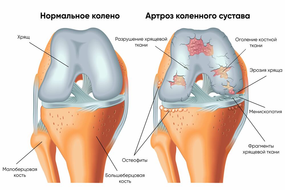 артроз коленного сустава (гонартроз) картинка