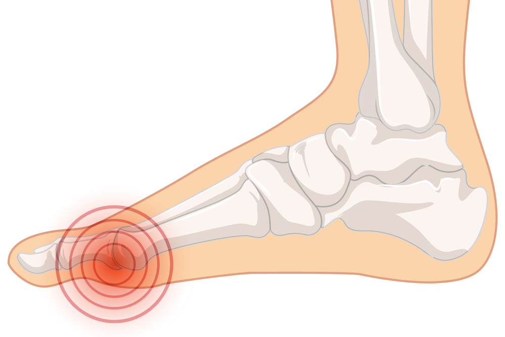 причины боли в суставе большого пальца стопы (ноги)